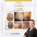 Formación privada Micropigmentación Capilar